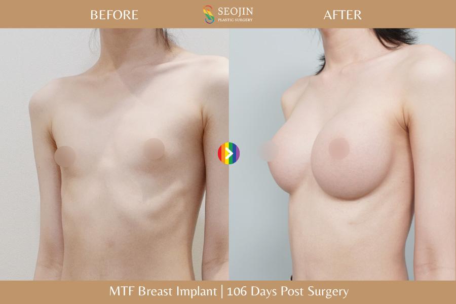 Seojin Plastic Surgery Clinic before and after image