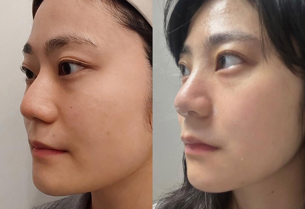 Female nose thread lift same day