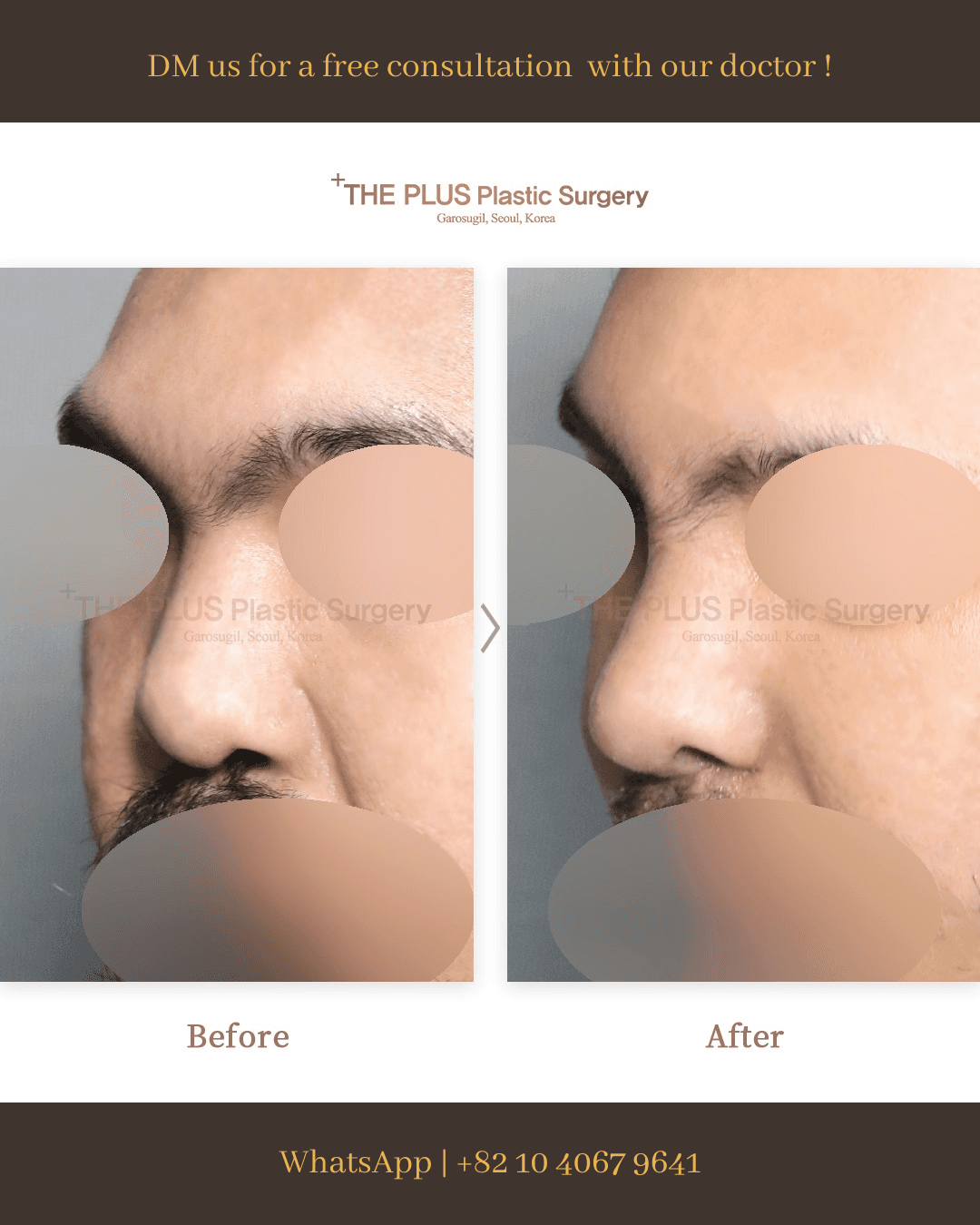 Cleft Lip Surgery, Cleft Palate Surgery