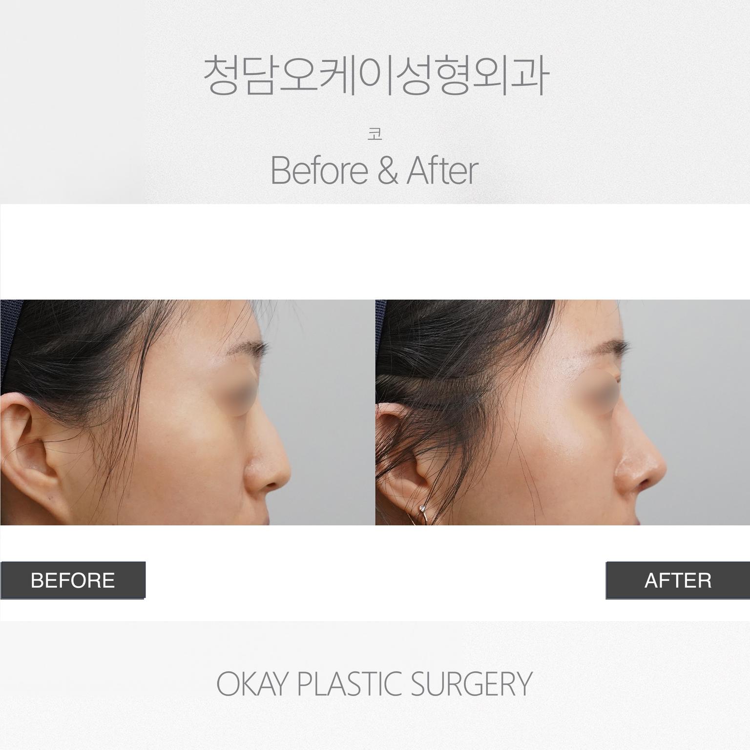 Okay Plastic Surgery Clinic before and after image
