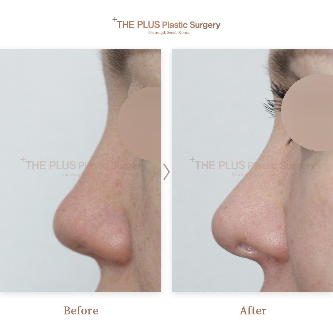 Primary Rhinoplasty & Lengthening & Rhinitis & Nasal Septum Deviation