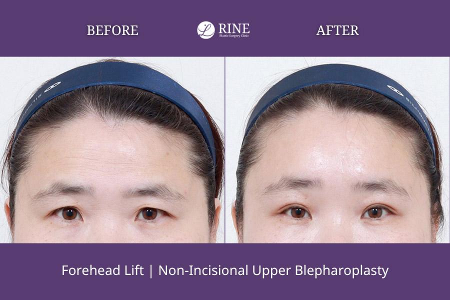 Forehead Lift non incisional upper blepharoplasty