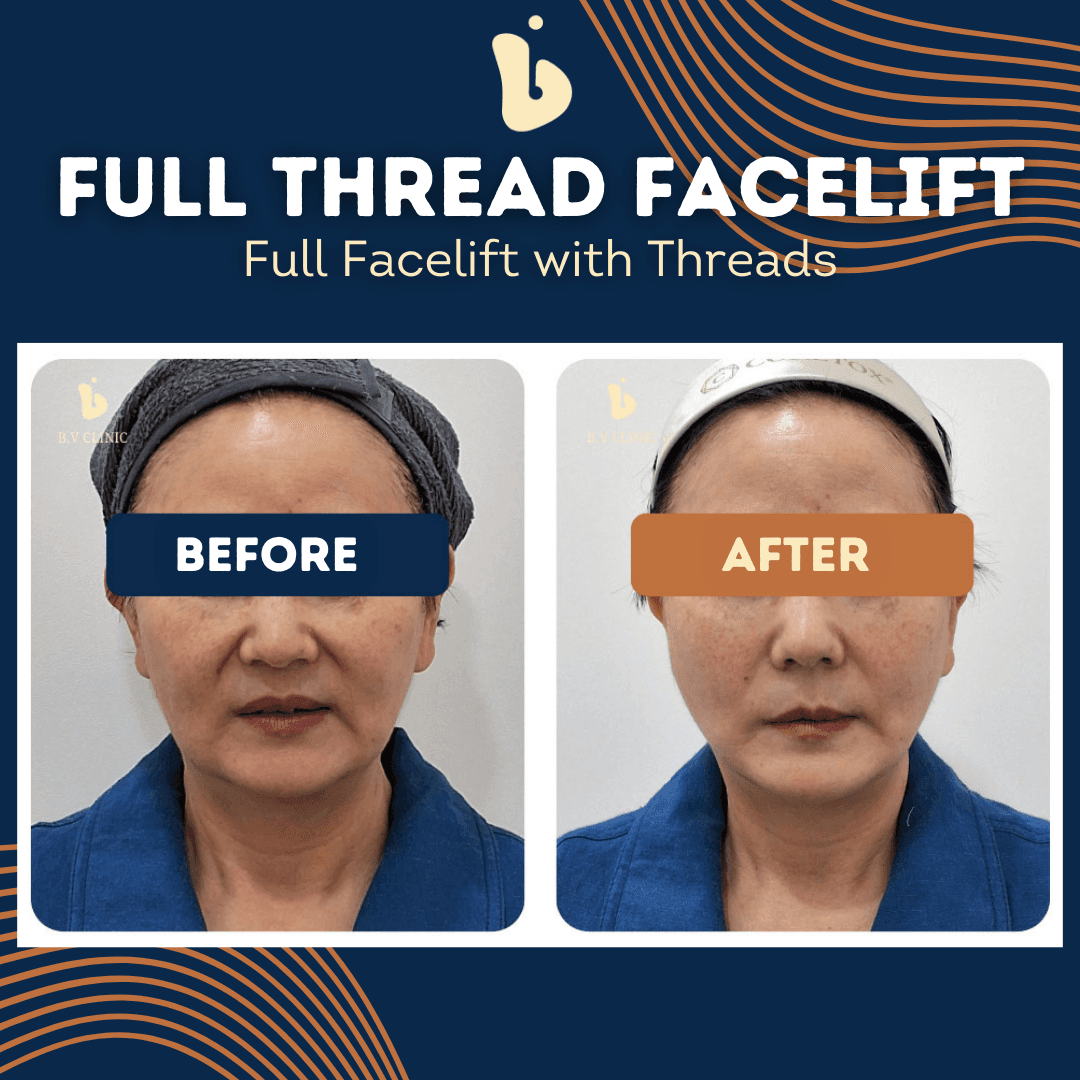 B.V Clinic before and after image