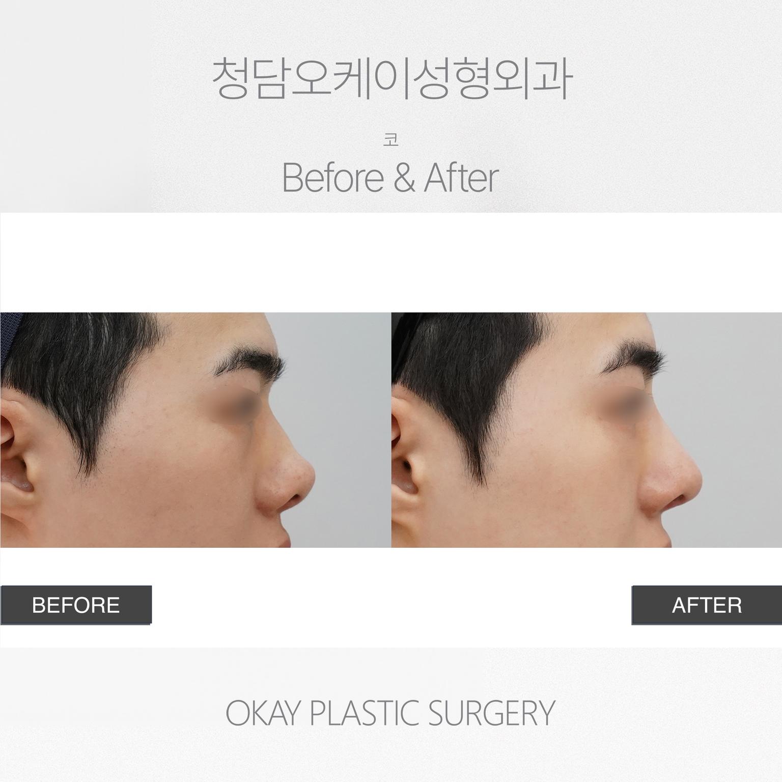 Okay Plastic Surgery Clinic before and after image