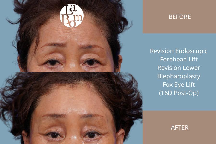 LABOM Plastic Surgery before and after image