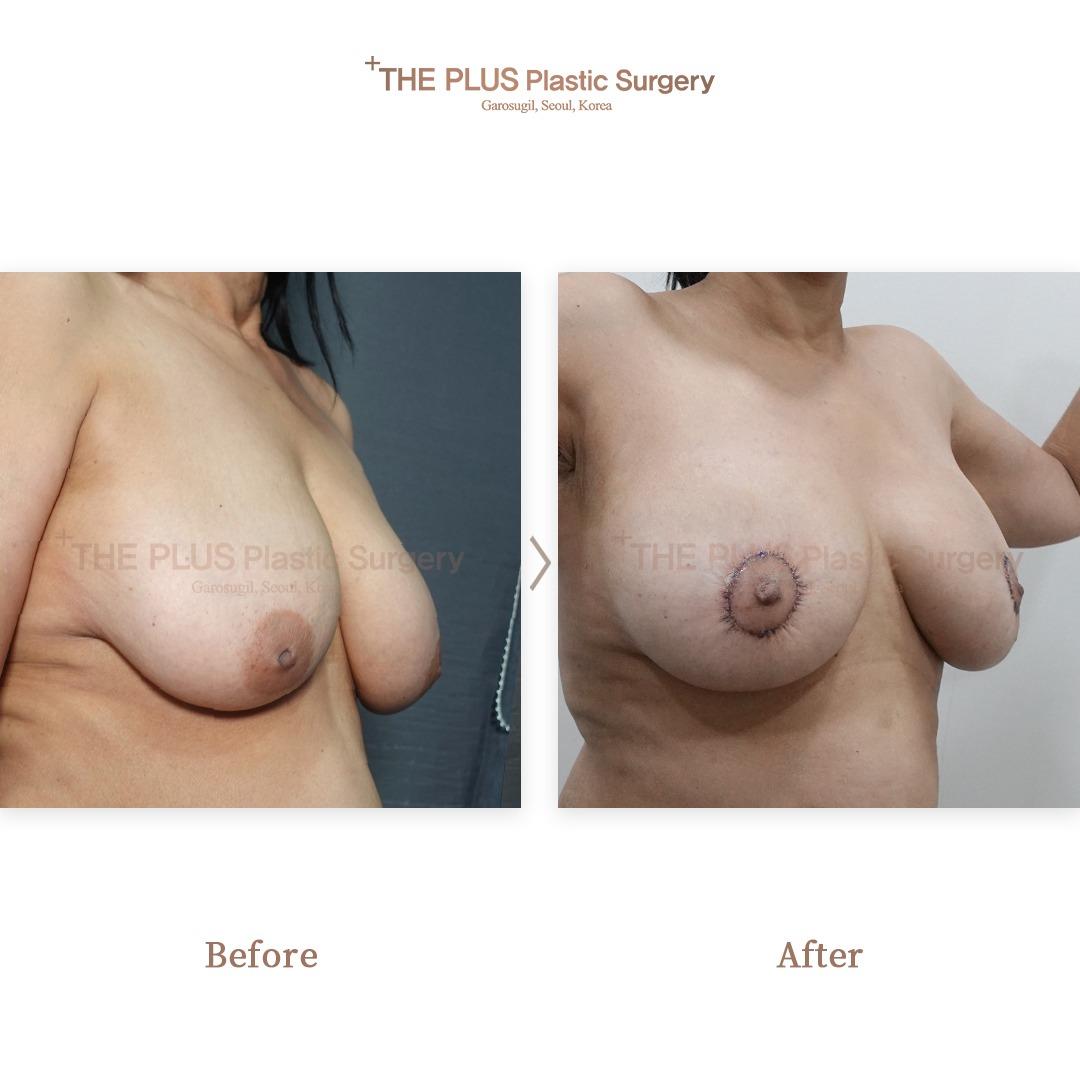 ThePlus Breast Lift & Inverted Nipple Surgery & Breast Fat Grafting