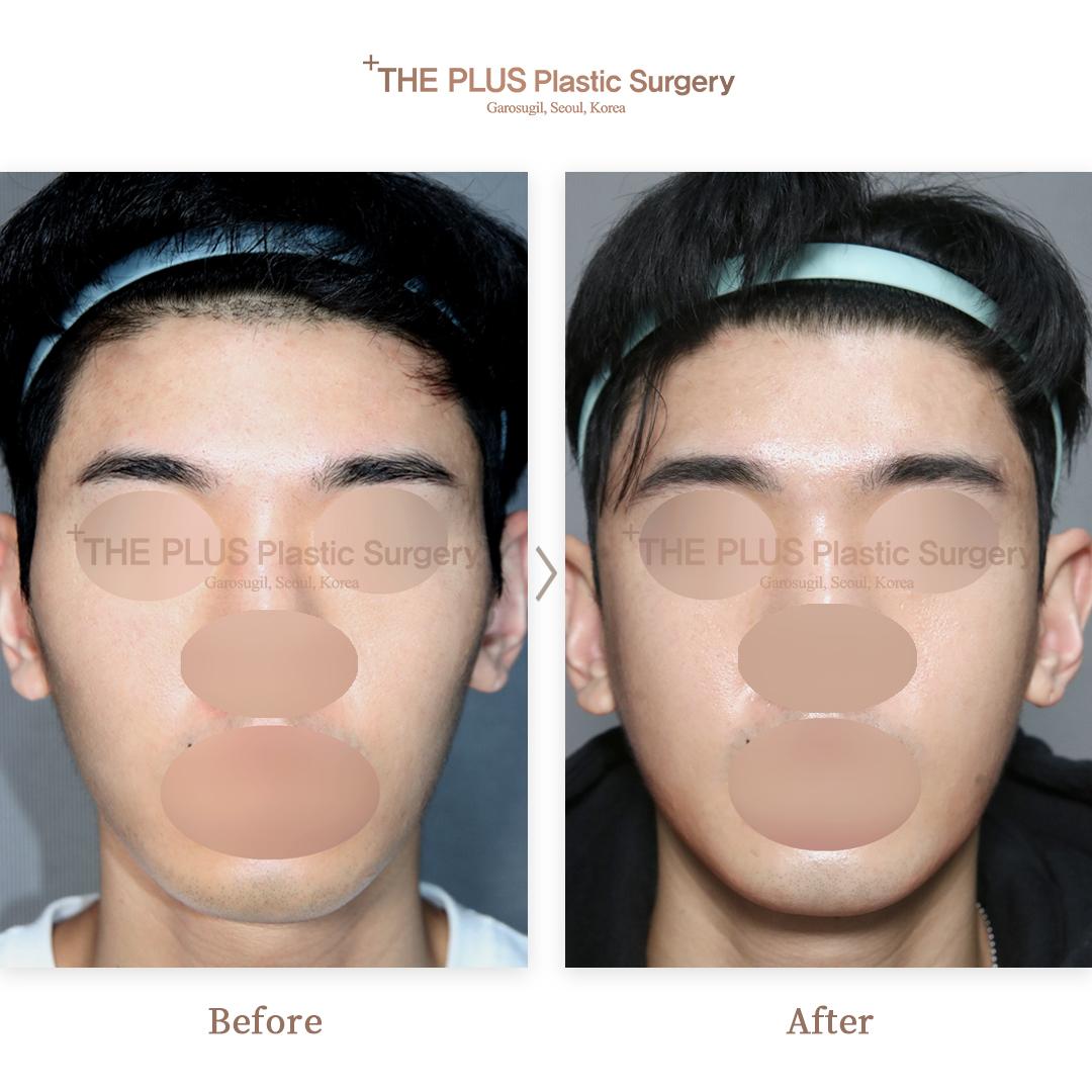 Zygoma Reduction