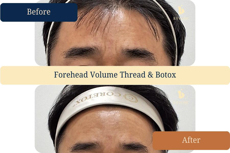 Glabellar Wrinkle Treatment with Volume Threads and Botox.