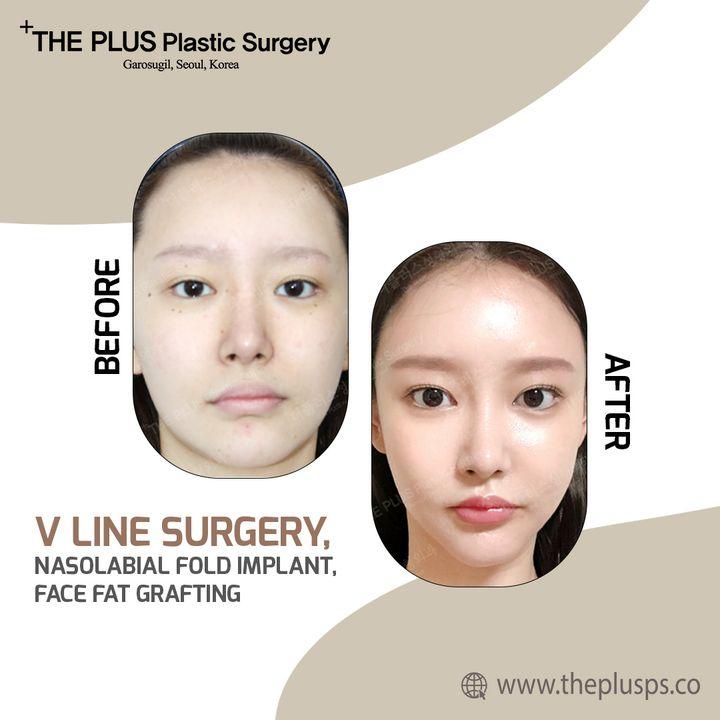 "đ§V-line surgeryđ§ is a procedure for people who want a sharp jawline and is usually considered along with square jaw surgery. It creates a natural âV-lineâ contour to the face. When combined with square jaw surgery, V-line surgery is designed to fit each individualâs lower jaw shape to avoid artificiality and to create a natural jaw line with a long curve or T-cut. For consulting a doctor visit our hospital or set an appointment from bellow waysđđđ