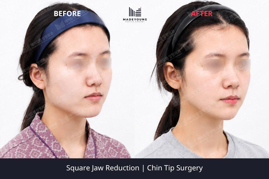 Jaw reduction chin tip surgery 1
