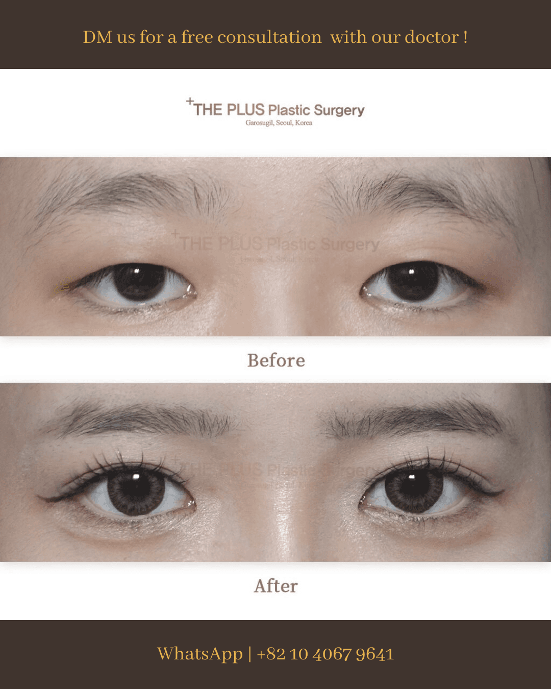 Ptosis Correction