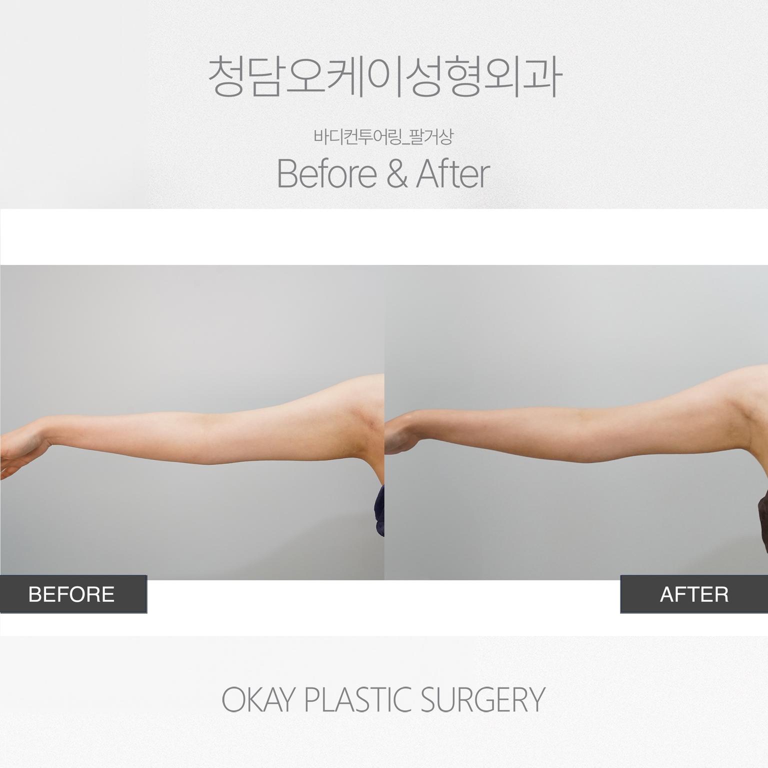 Okay Plastic Surgery Clinic before and after image