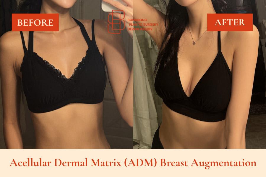 Acellular Dermal Matrix (ADM) Breast Augmentation