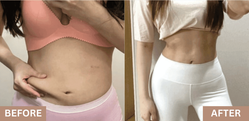 lydian-female-5d-liposuction-07.png