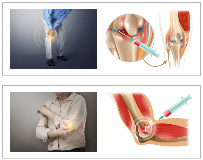 Stem Cells For Knee Cartilage Regeneration, Autologous Stem Cell Therapy