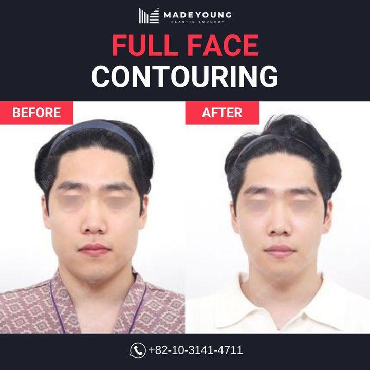 Transform your facial aesthetics with our Full Face Contouring service. Our before and after images highlight the bespoke enhancements possible, from jawline to cheekbones, for a harmoniously balanced visage. #FullFaceContouring #SculptedBeauty
