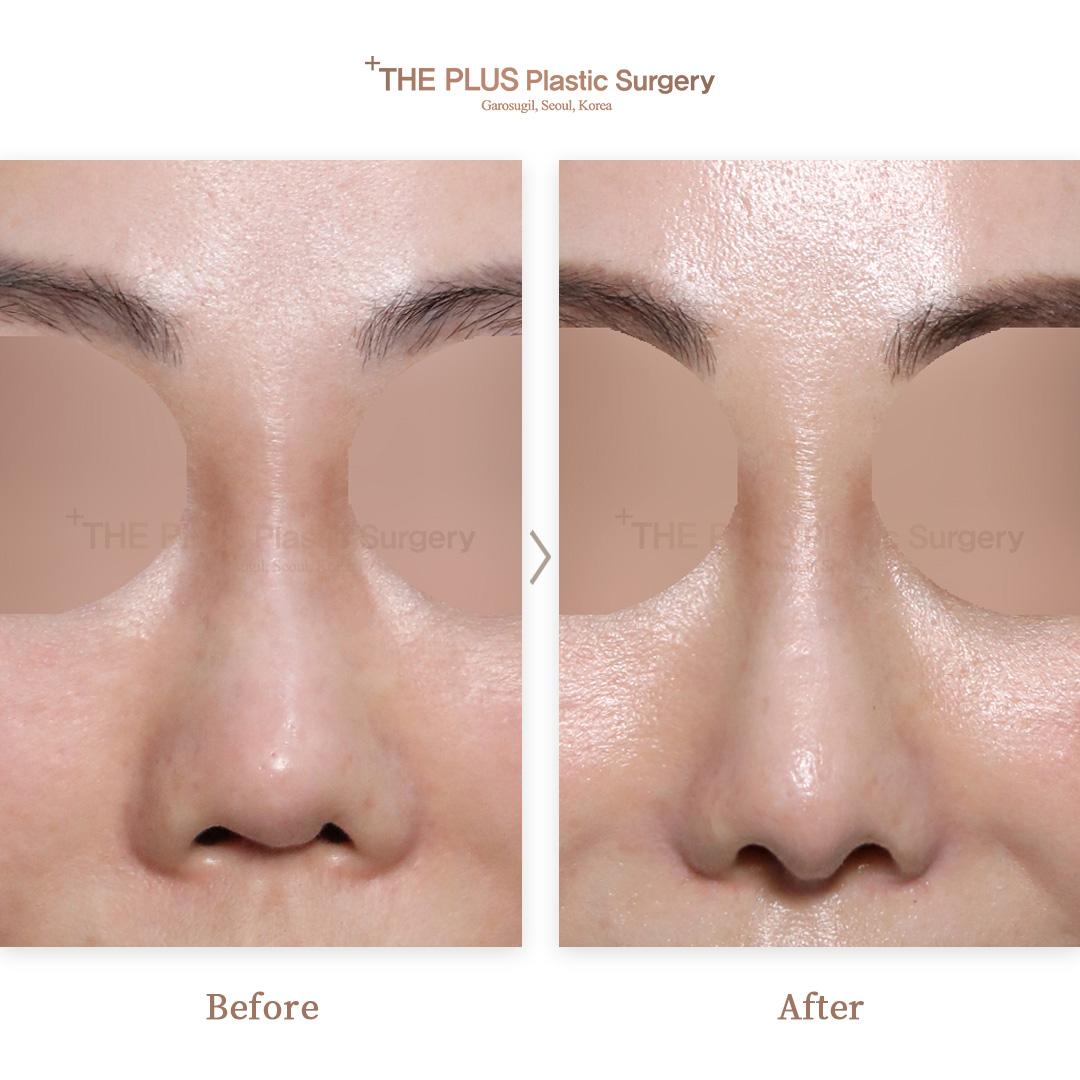 4. Revisionsrhinoplastik & Entzündungsentfernung & Ohrknorpel & Rippenknorpel & Verlängerung