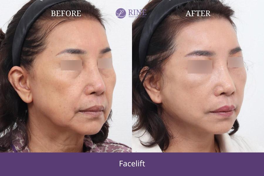 SMAS Facelift