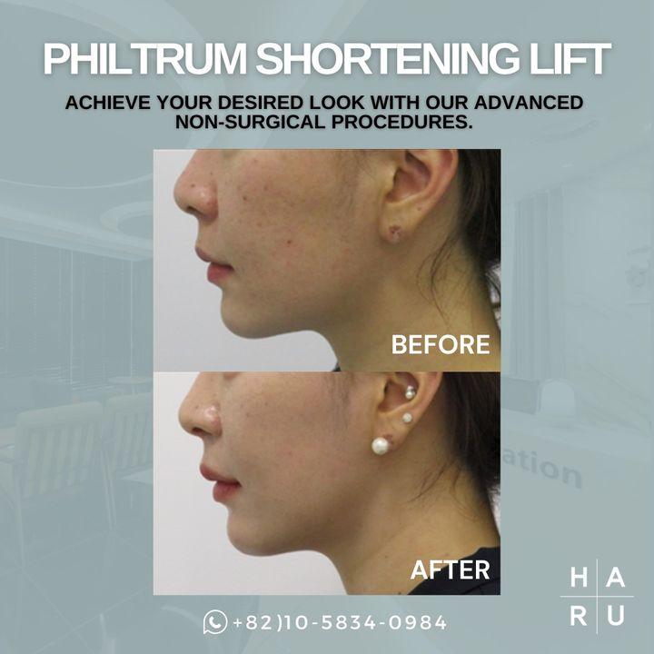 Our non-surgical philtrum shortening lift can help you achieve a more balanced and youthful facial appearance. 🌈