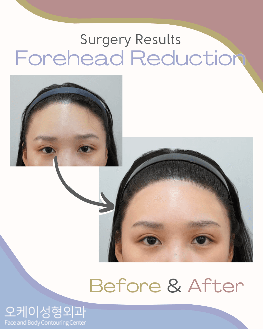 Forehead Reduction