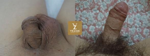 Before and After Penis Enlargement