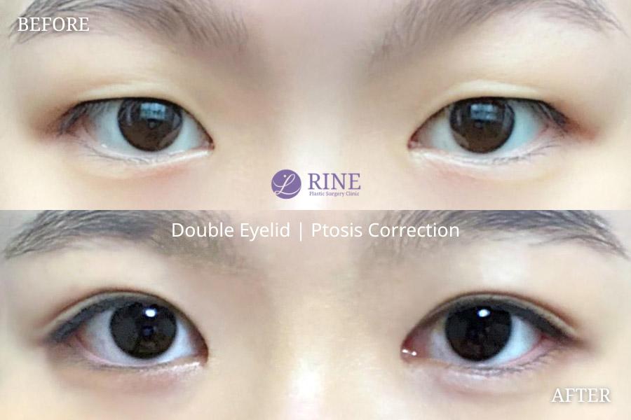 Double Eyelid ptosis correction