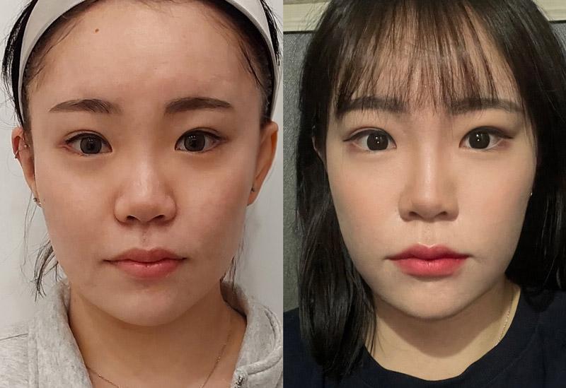 Female nose thread lift 3 monthjpg