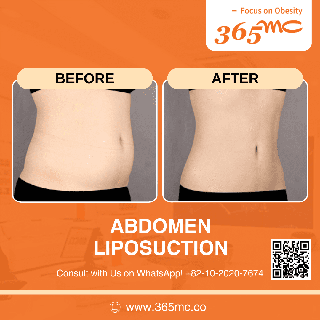 bna-abdomen-iiposuction-02.png