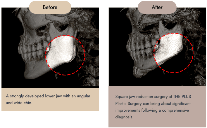 Square Jaw Surgery
