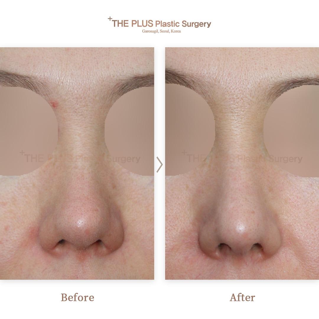 THEPLUS Plastic Surgery before and after image