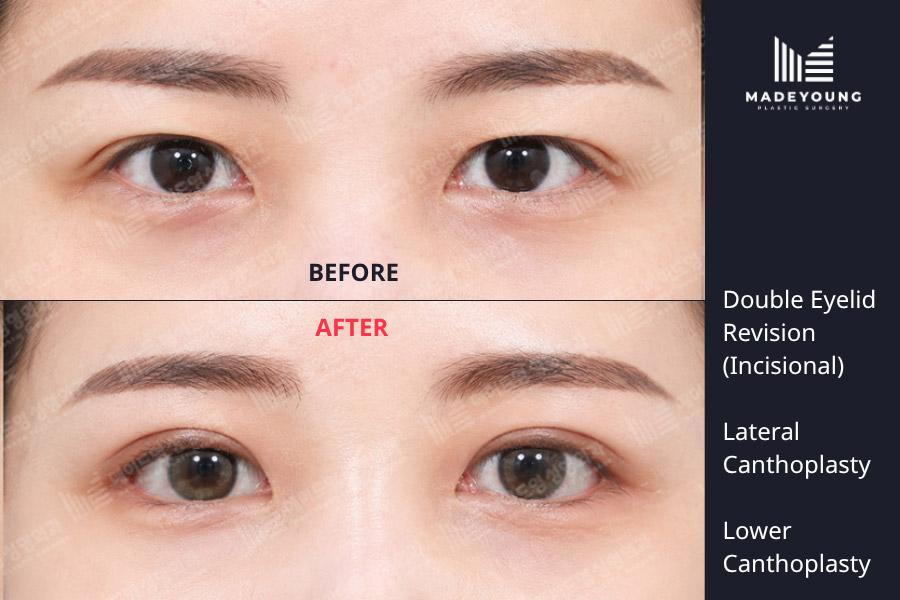 Eyelid revision incisional lateral canthoplasty lower canthoplasty