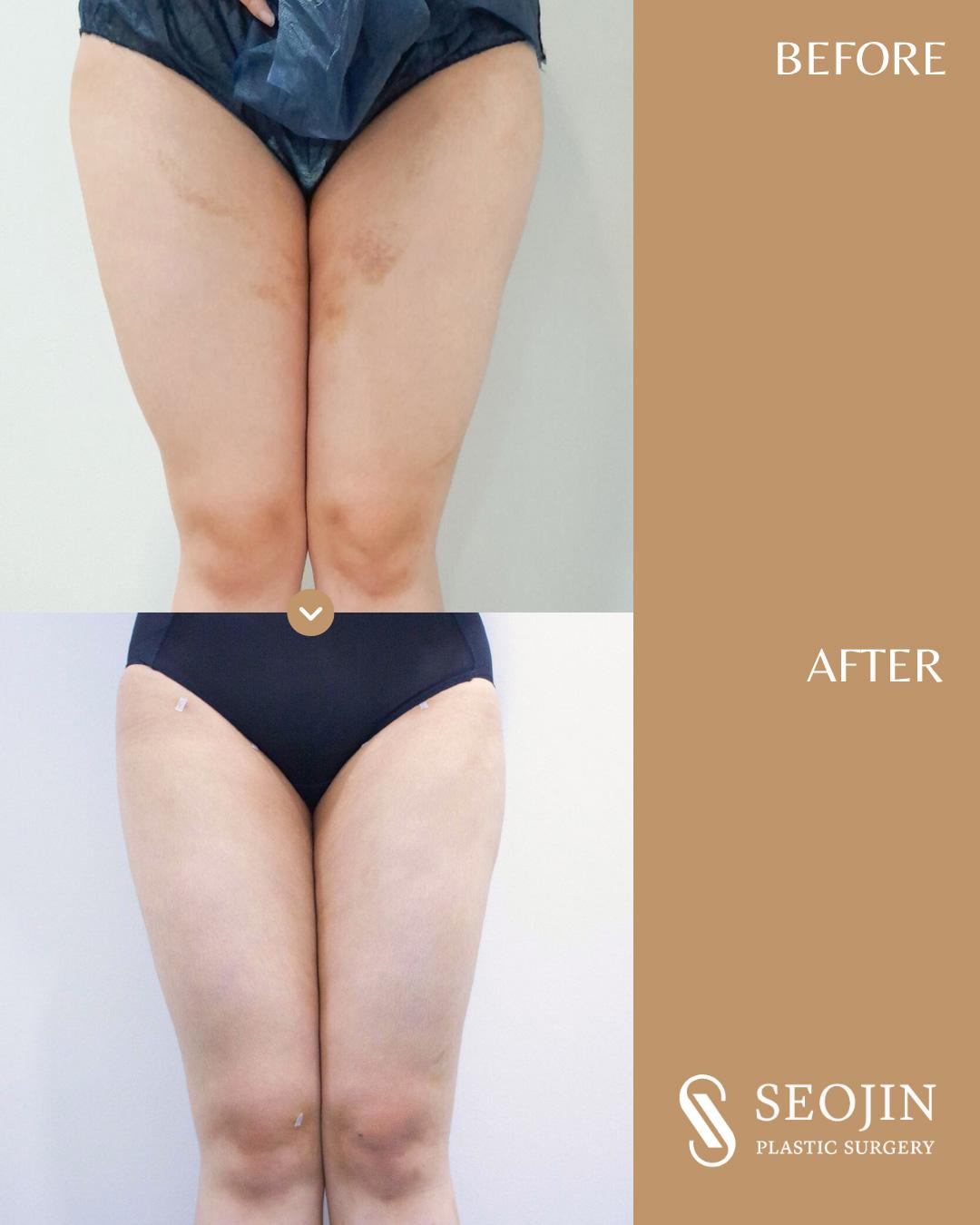 seojin-thigh-liposuction-2