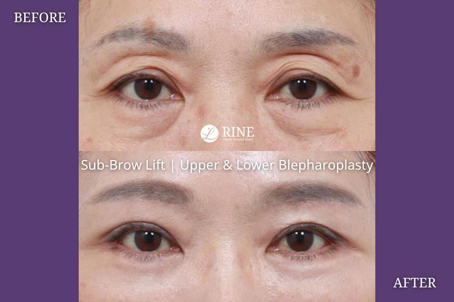 Sub Brow lift upper blepharoplasty