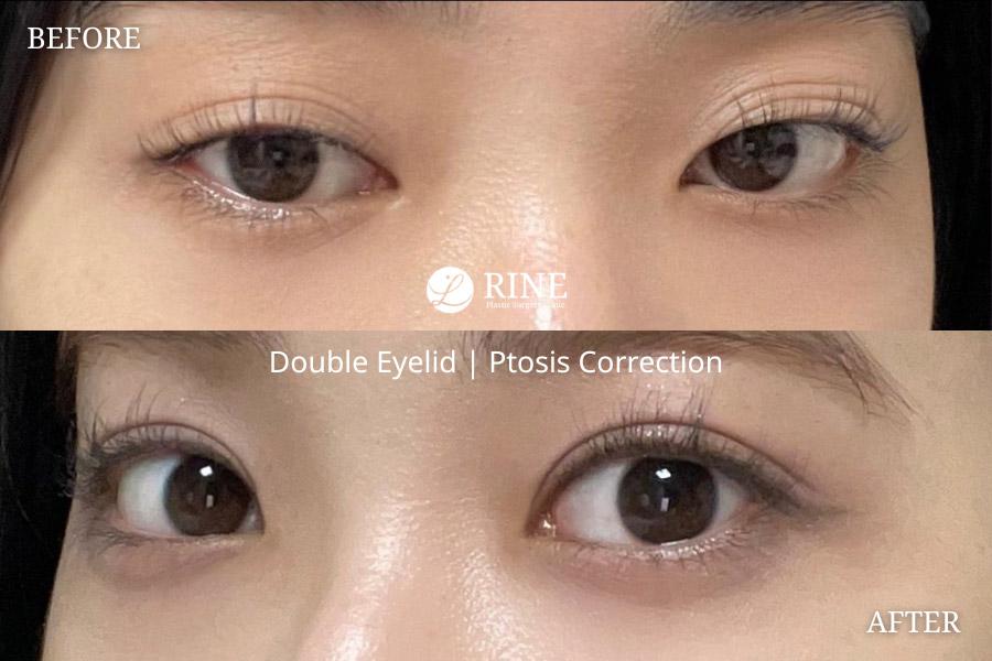 Double Eyelid ptosis correction