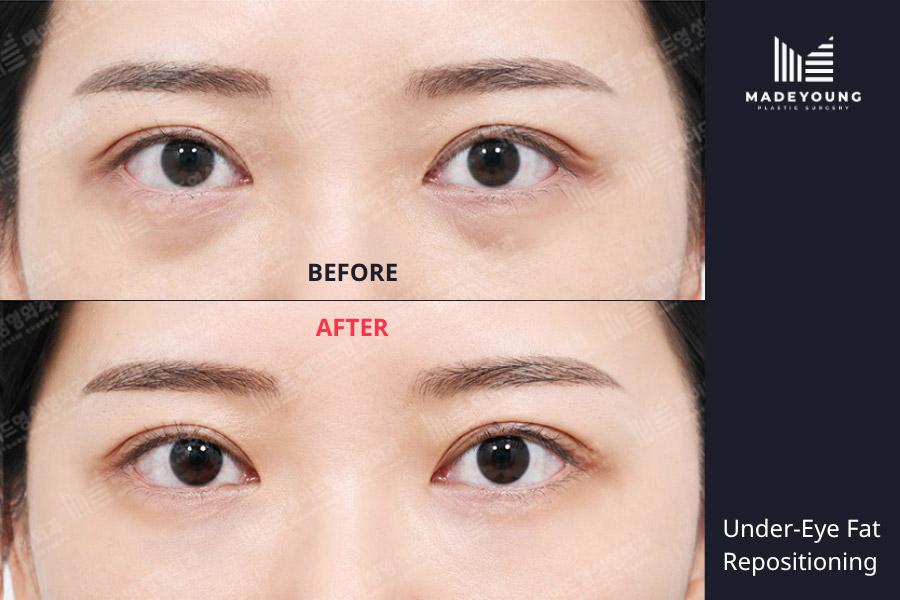 Eye fat repositioning