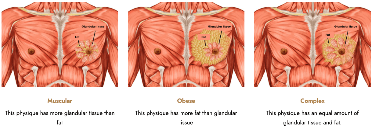 Gynecomastia