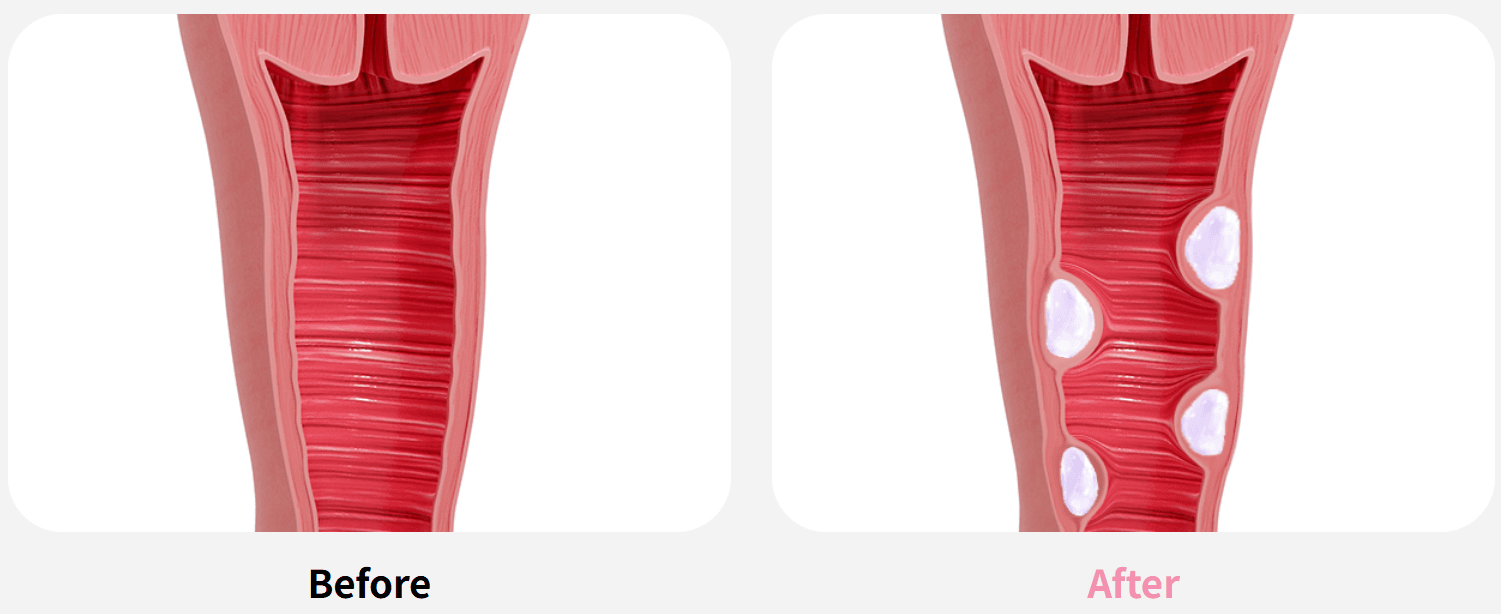 Vaginal Filler