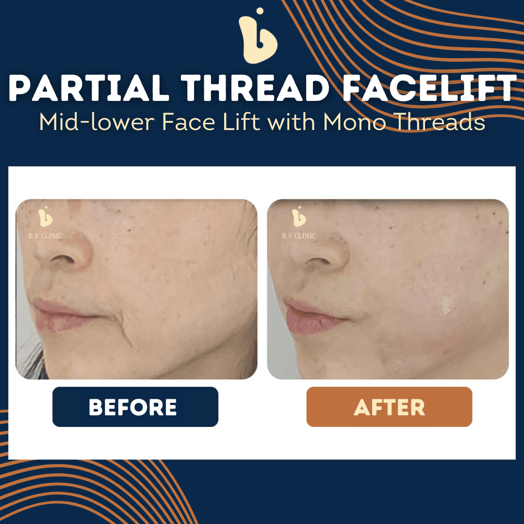 B.V Clinic before and after image