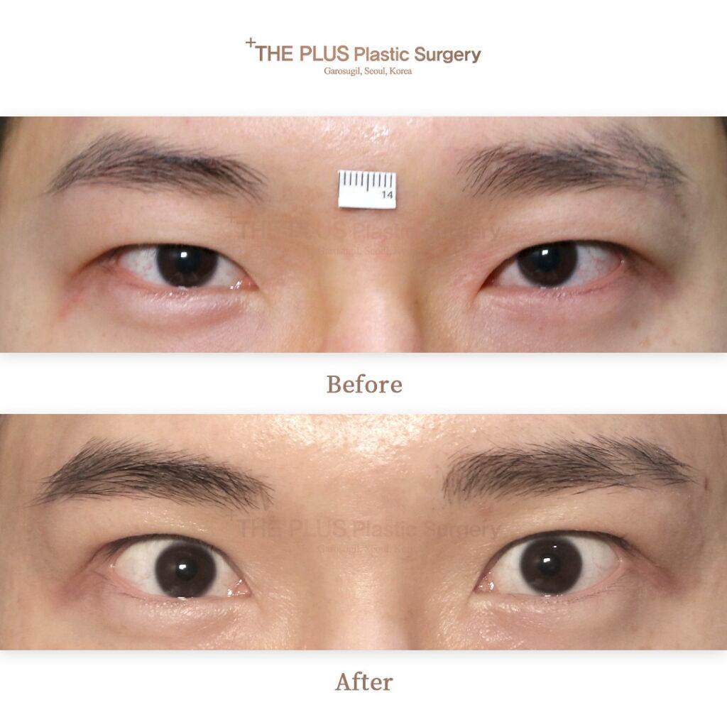 Ptosis Correction