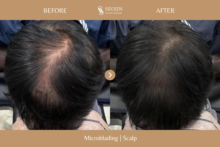 Vorher-Nachher-Bild der Seojin Plastic Surgery Clinic
