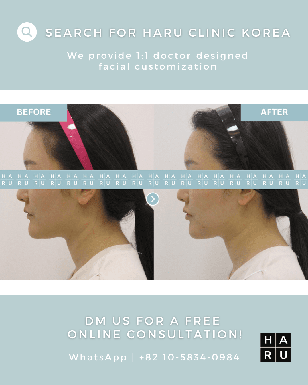 Lippenfiller, Mundwinkel-Lift mit Botox