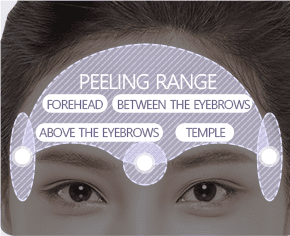 Forehead Lift