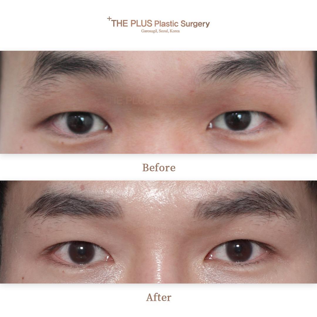 Double eyelid surgery (partial incision)