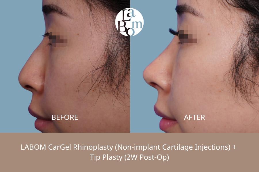 Before and After Non-Surgical Rhinoplasty