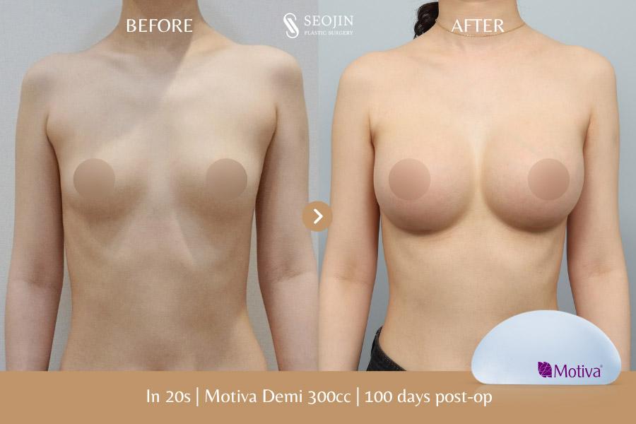 Seojin Plastic Surgery Clinic before and after image