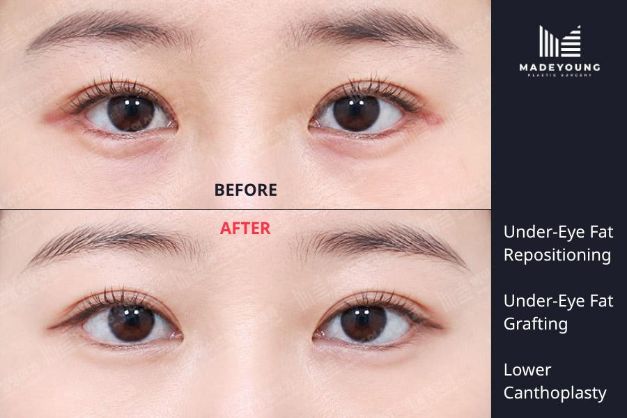 Eye fat repositioning under eye fat grafting lower canthoplasty