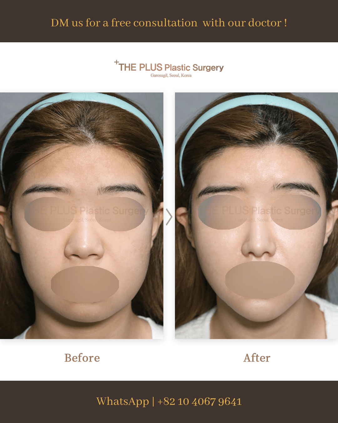 Chin Implant, Face Contouring, Face Fat Grafting