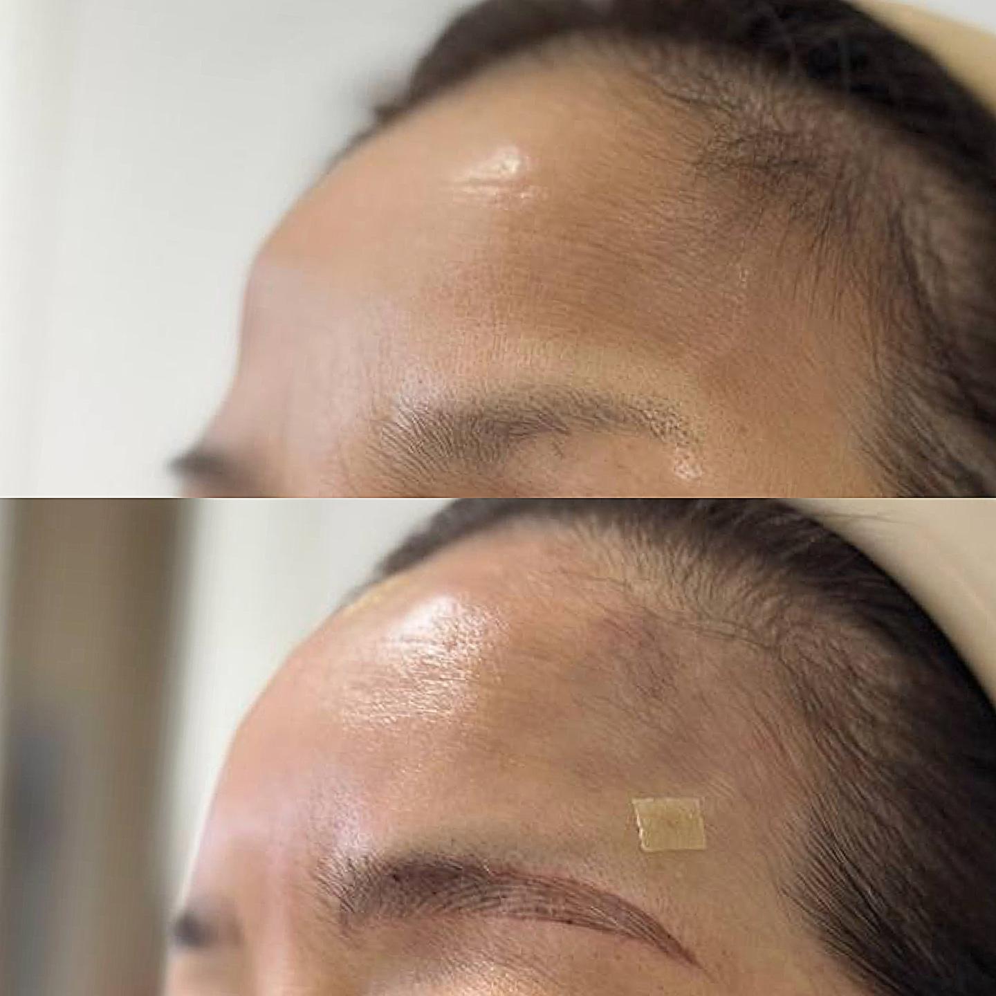 Forehead Filler