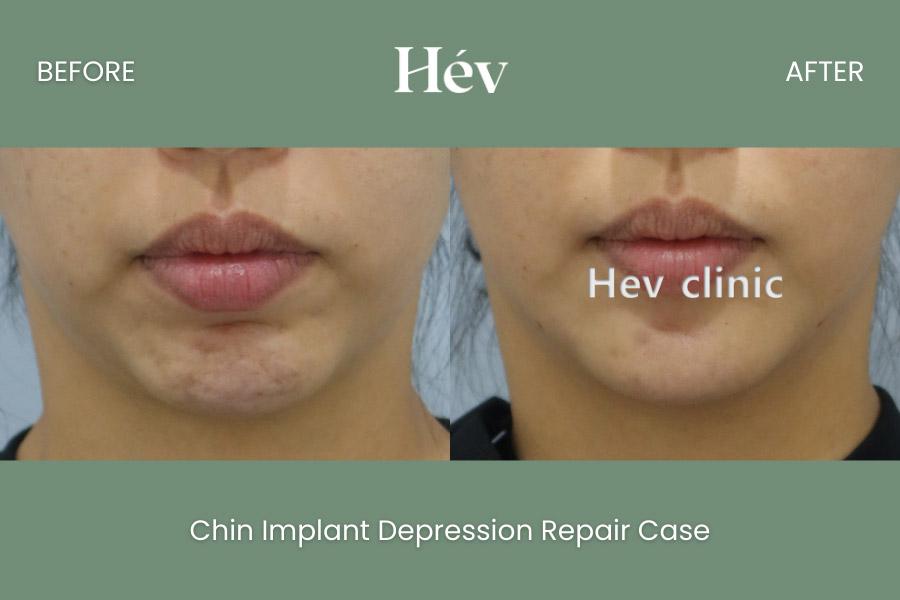 Hev Chin Implant Depression Repair Case
