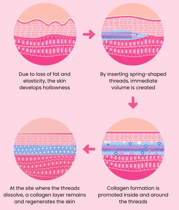 Filling Threads